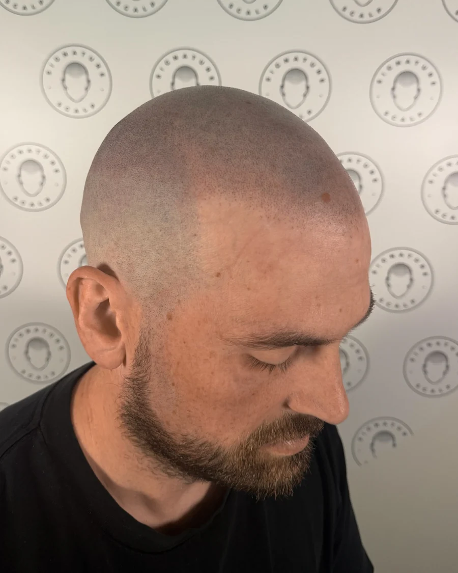 Scalp micropigmentation result at Signature Scalp, side view