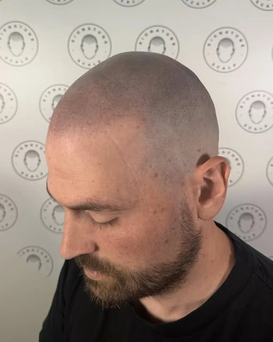 Scalp micropigmentation result, receding hairline, side view