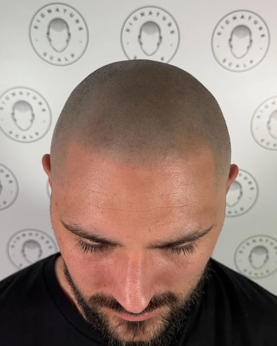 Scalp micropigmentation result, front view