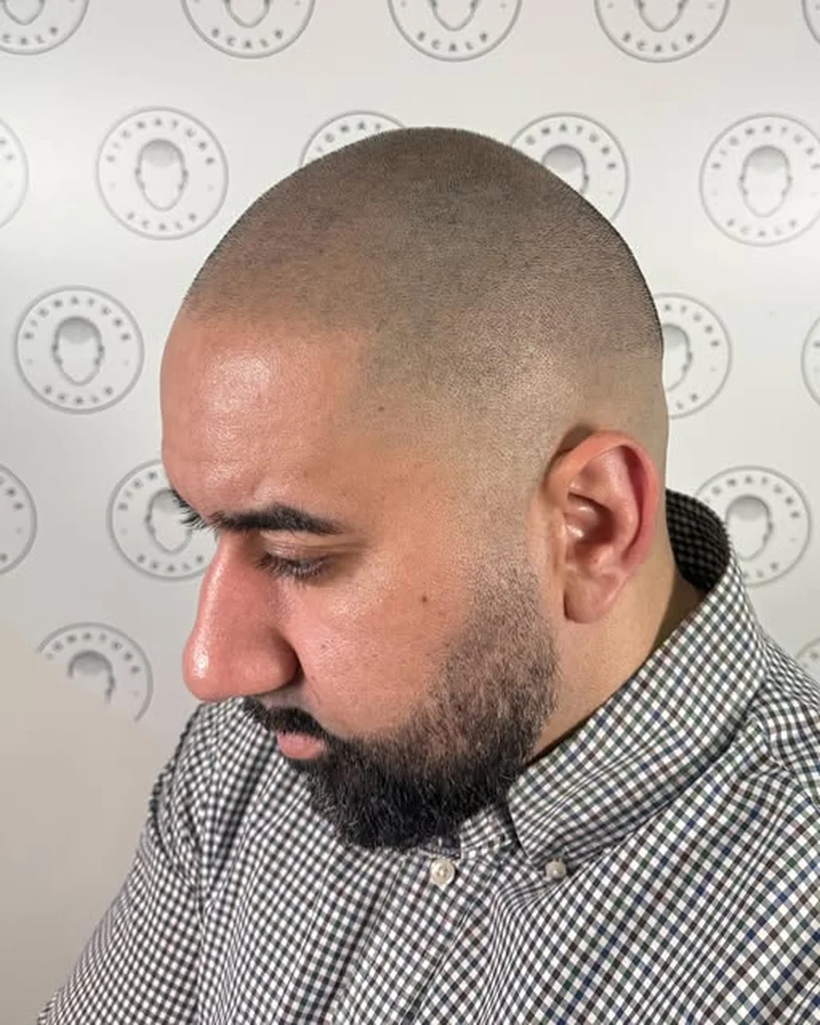 Scalp micropigmentation result, hairline, side profile