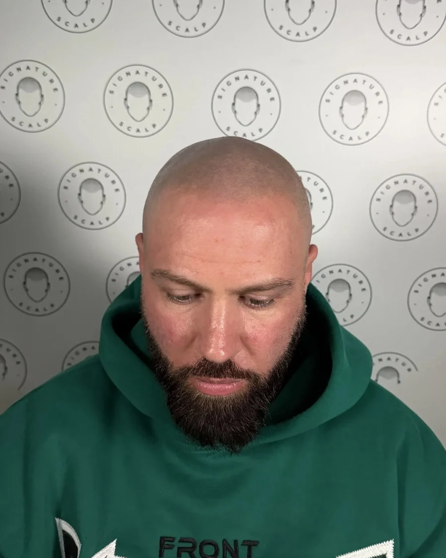 Scalp micropigmentation result, full scalp, front view